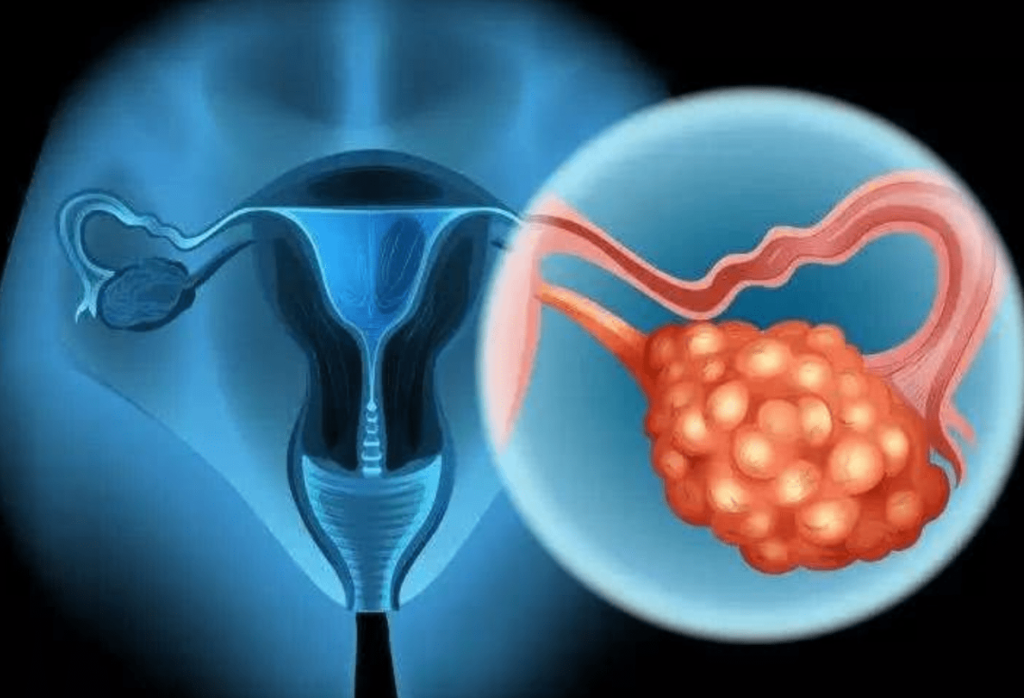 美国卵巢癌放疗有哪些优势？卵巢癌美国就医医院推荐