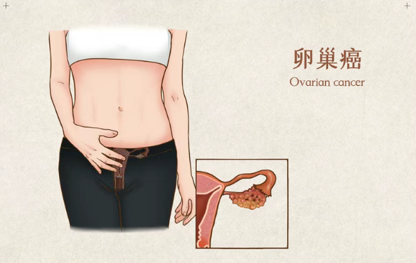 29%患者5年未进展!PARP抑制剂Rubraca为晚期卵巢癌带来长期控制希望