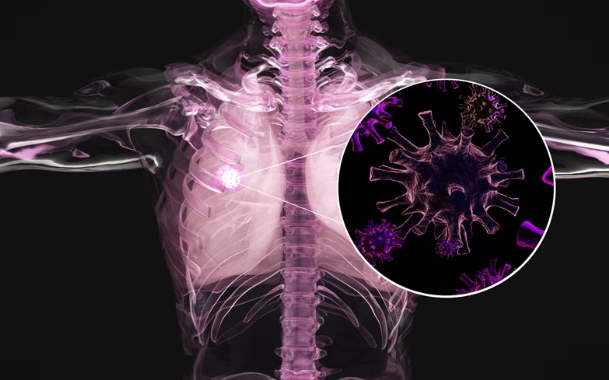 欧洲肺癌大会:免疫治疗新药Gotistobart让晚期肺癌患者活得更久,死亡风险降低54%!